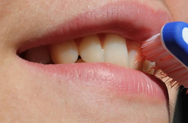 What is gingivitis?