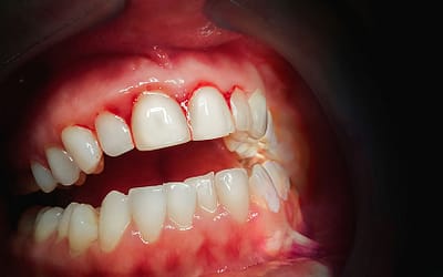 Is it possible to reverse periodontal disease?